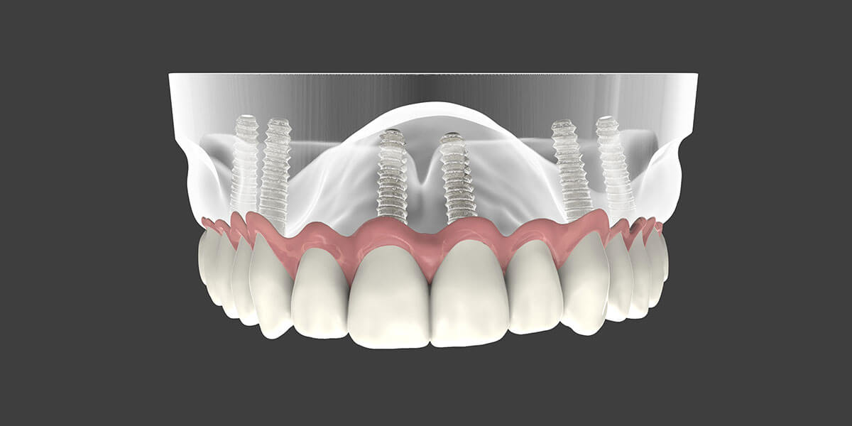 Dental Implant Supported Dentures in ND