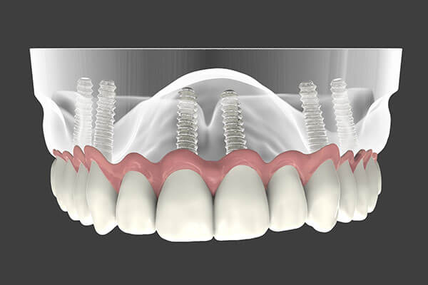 Implant Supported Dentures in Minot, ND