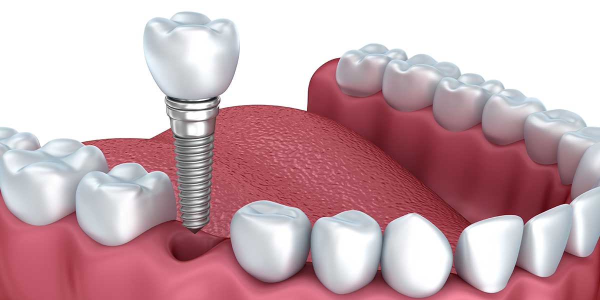 Single Dental Implants in Minot, ND