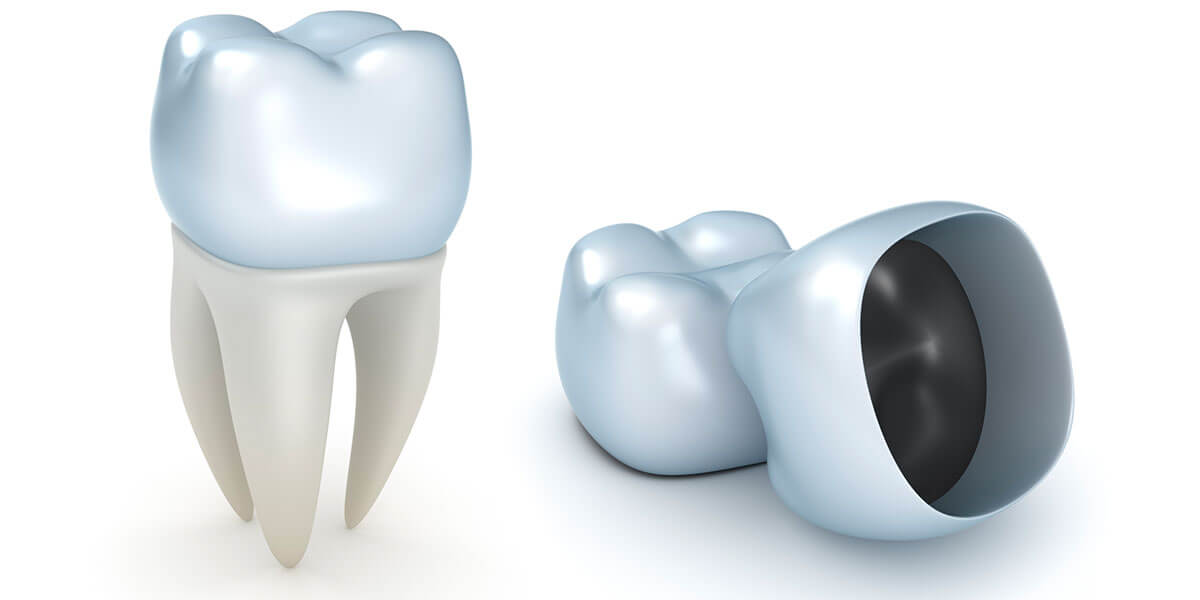 Dental crowns illustration