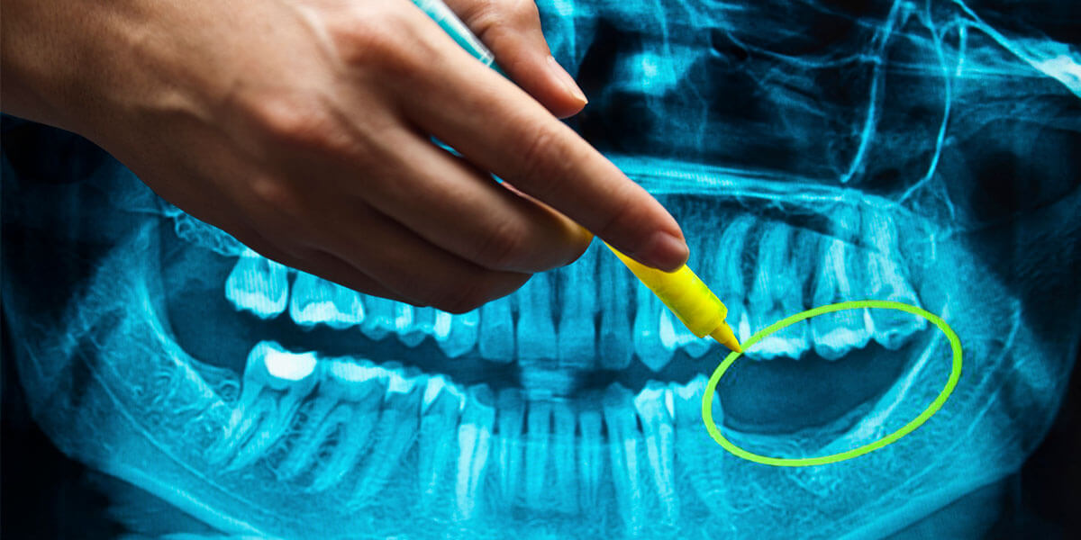 Benefits of Dental Implants in Minot, ND