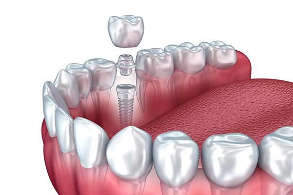 Dental Implant Restorations in Minot