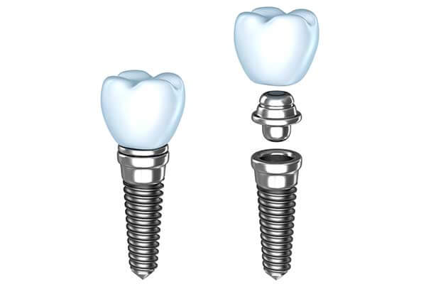 Single Dental implants in Minot, ND