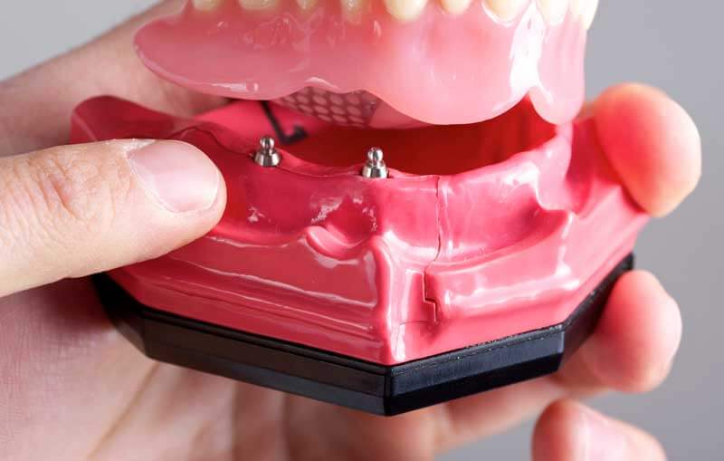 Mini Dental Implants in Minot