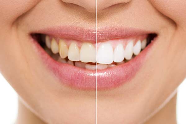 Before & After Teeth Whitening in Minot