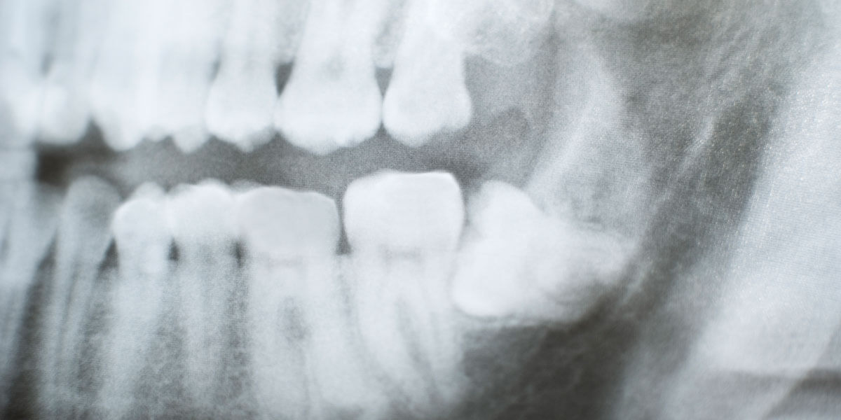 xray showing impacted wisdom teeth